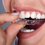 Invisalign-behandling