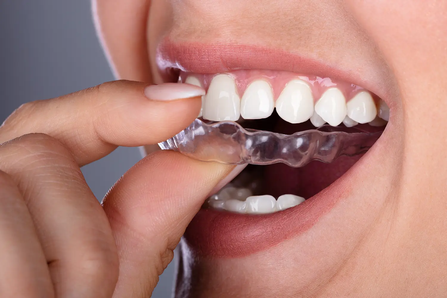Invisalign